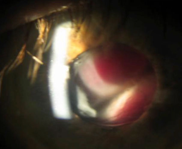 Рисунок 28.3. Массивная ШМ. У этого пациента была массивная ШМ, которая была видна через зрачок